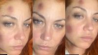 Lourdes, de Bandana, denunció a su ex por violencia y mostró su cara golpeada