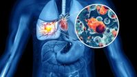 Cáncer de pulmón: la comunidad científica insiste para que más personas se realicen un chequeo clave